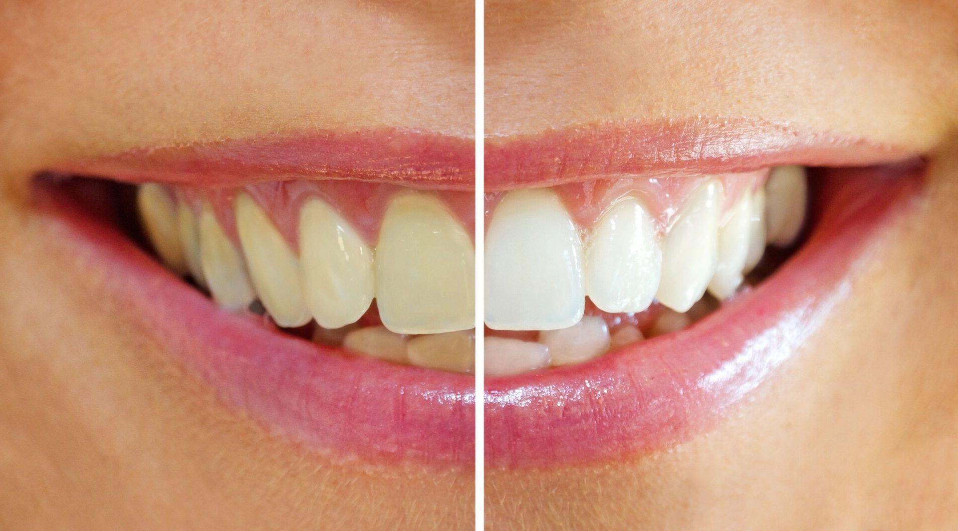 A before and after picture of teeth whitening